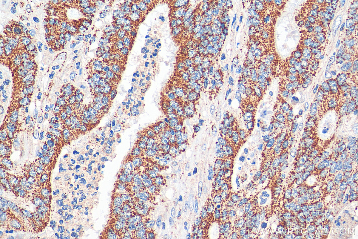 IHC staining of human colon cancer using 17053-1-AP