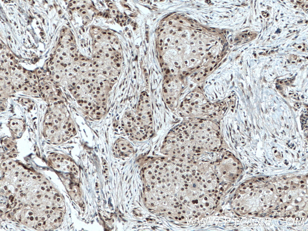 Immunohistochemistry (IHC) staining of human breast cancer tissue using TDG Monoclonal antibody (66707-1-Ig)