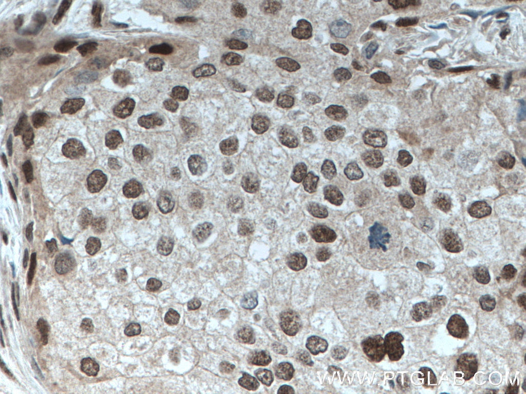 Immunohistochemistry (IHC) staining of human breast cancer tissue using TDG Monoclonal antibody (66707-1-Ig)