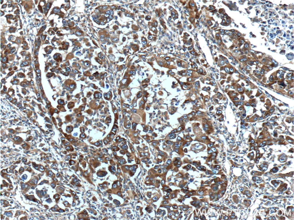 Immunohistochemistry (IHC) staining of human liver cancer tissue using TDO2 Polyclonal antibody (15880-1-AP)