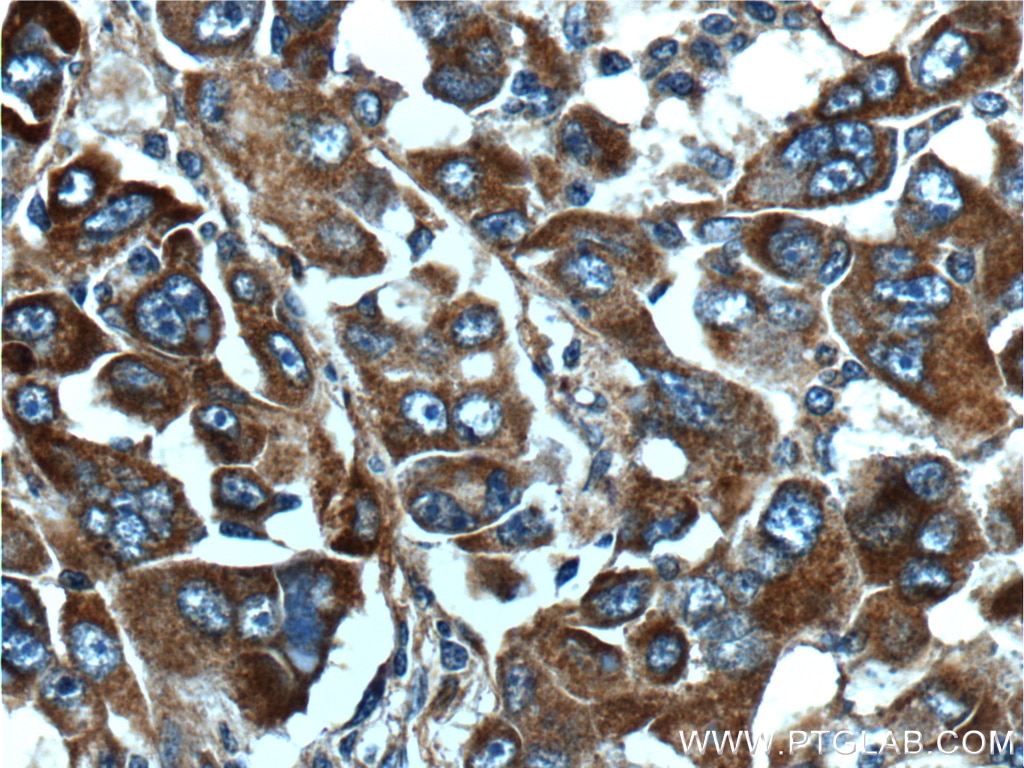 Immunohistochemistry (IHC) staining of human liver cancer tissue using TDO2 Polyclonal antibody (15880-1-AP)