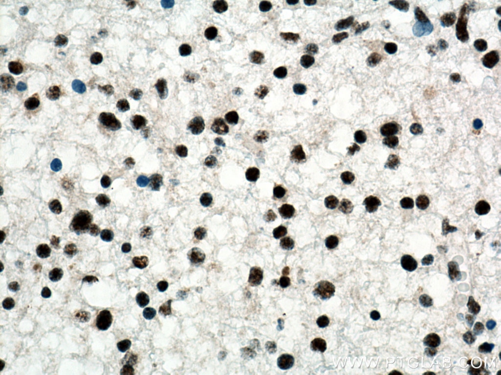 IHC staining of human gliomas using 67345-1-Ig