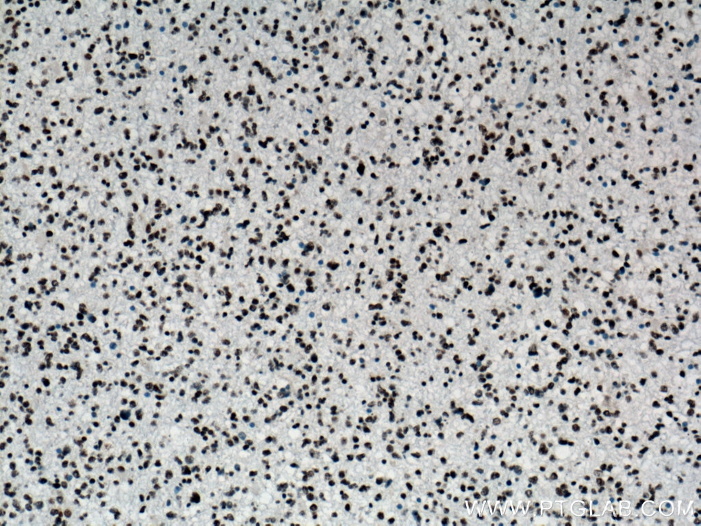 Immunohistochemistry (IHC) staining of human gliomas tissue using TDP-43 Monoclonal antibody (66734-1-Ig)