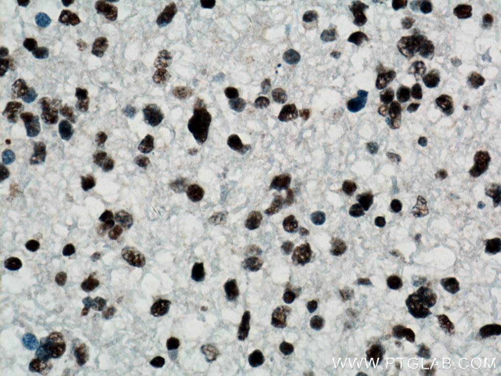 IHC staining of human gliomas using 66734-1-Ig