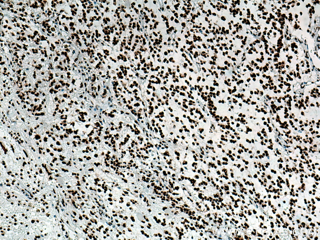 Immunohistochemistry (IHC) staining of human gliomas tissue using TDP-43 Recombinant antibody (80001-1-RR)
