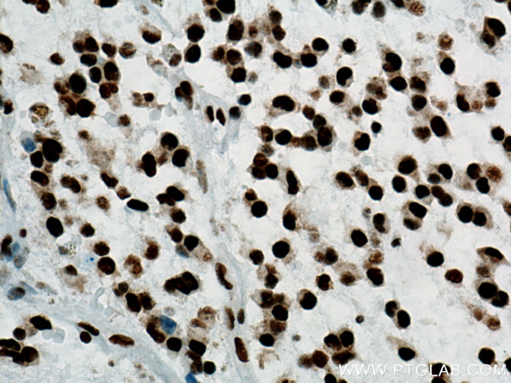 Immunohistochemistry (IHC) staining of human gliomas tissue using TDP-43 Recombinant antibody (80001-1-RR)