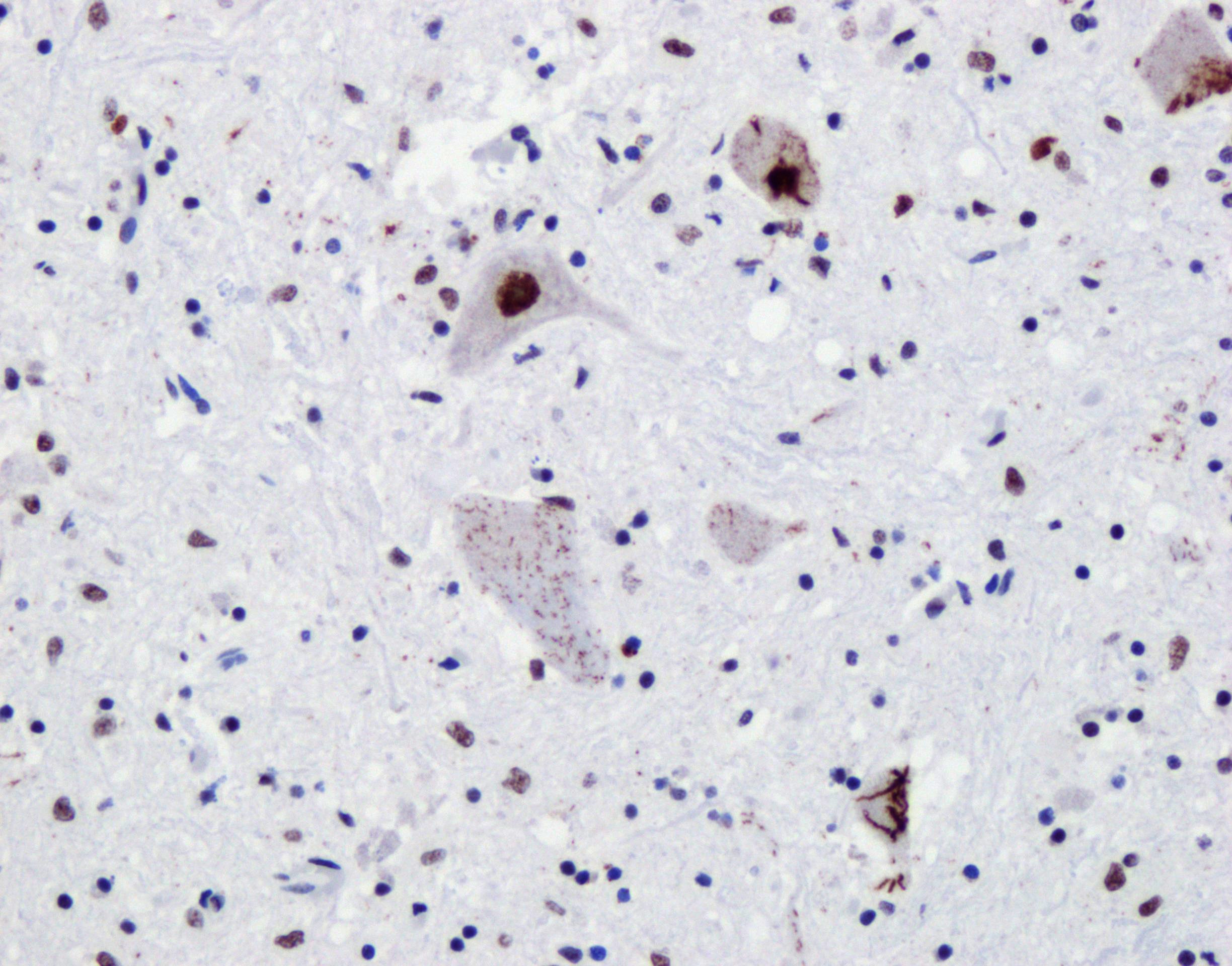 Immunohistochemistry (IHC) staining of spinal cord slides from ALS patients using TDP-43 Recombinant antibody (80001-1-RR)