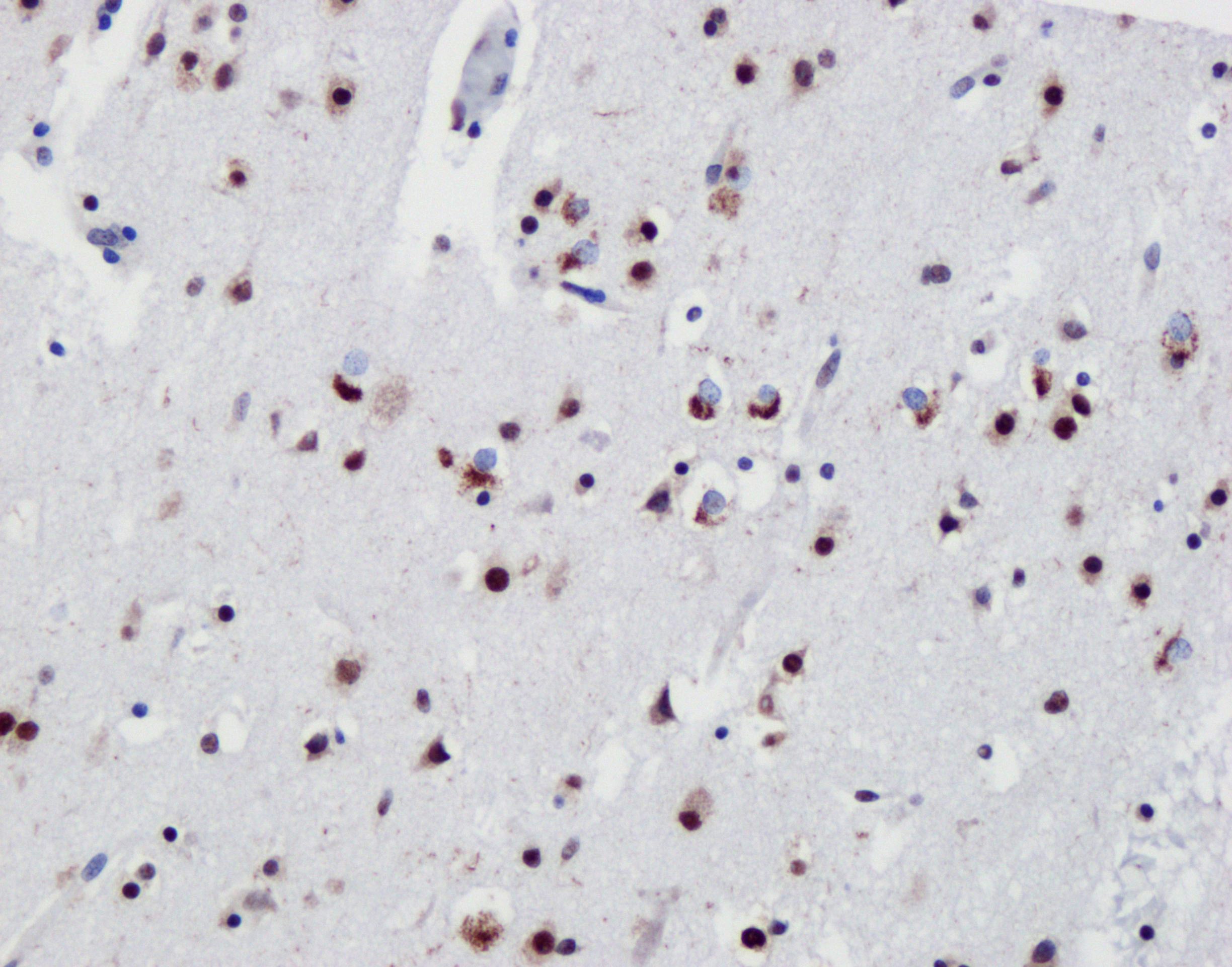 Immunohistochemistry (IHC) staining of frontal cortex from FTLD-TDP type B using TDP-43 Recombinant antibody (80001-1-RR)