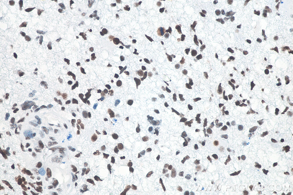 IHC staining of human gliomas using 80001-1-RR Immunohistochemistry (IHC) staining of human gliomas tissue using TDP-43 (N-terminal) Recombinant monoclonal antibod (80001-1-RR)