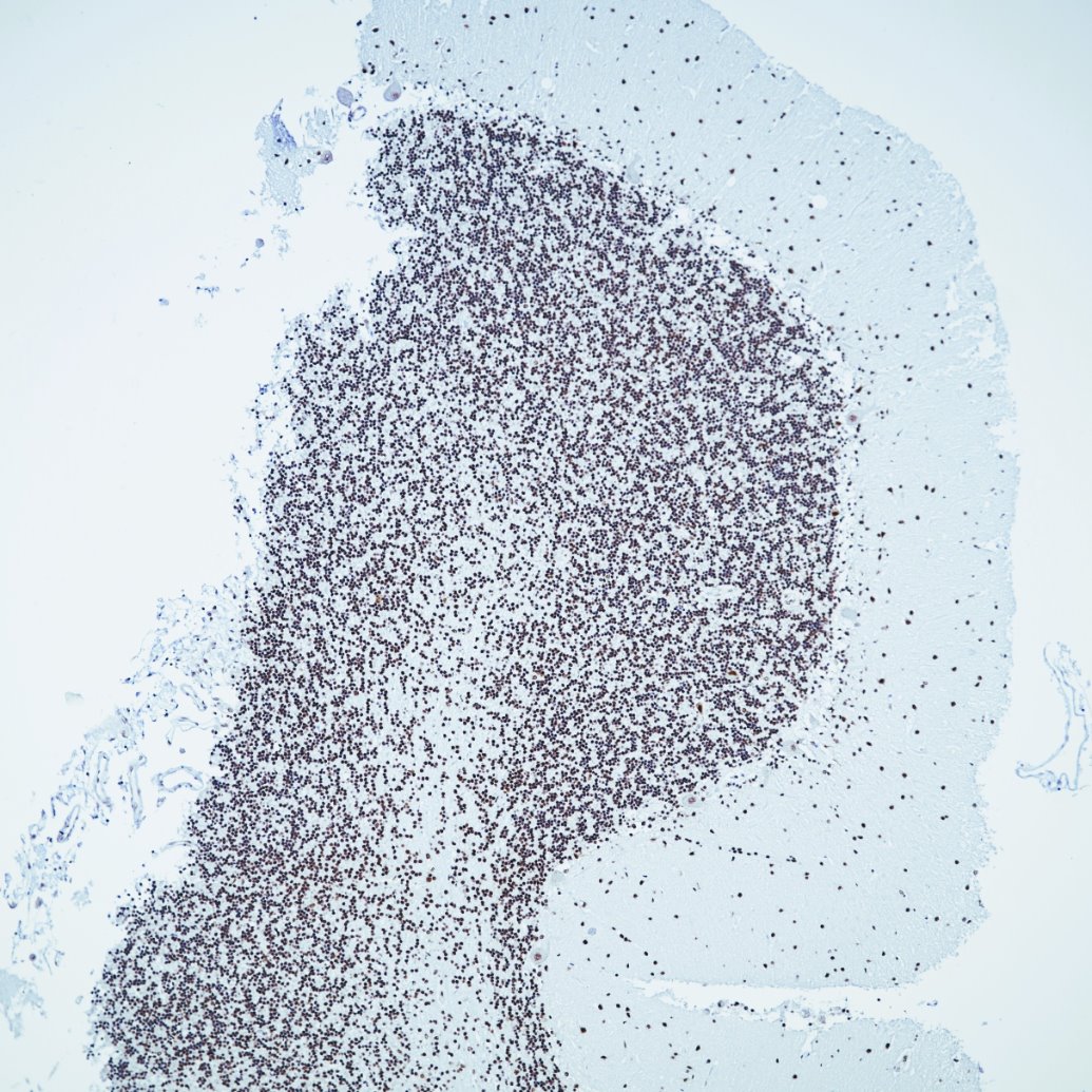 Immunohistochemistry (IHC) staining of human brain tissue using TDP-43 (N-terminal) Recombinant monoclonal antibod (80002-1-RR)