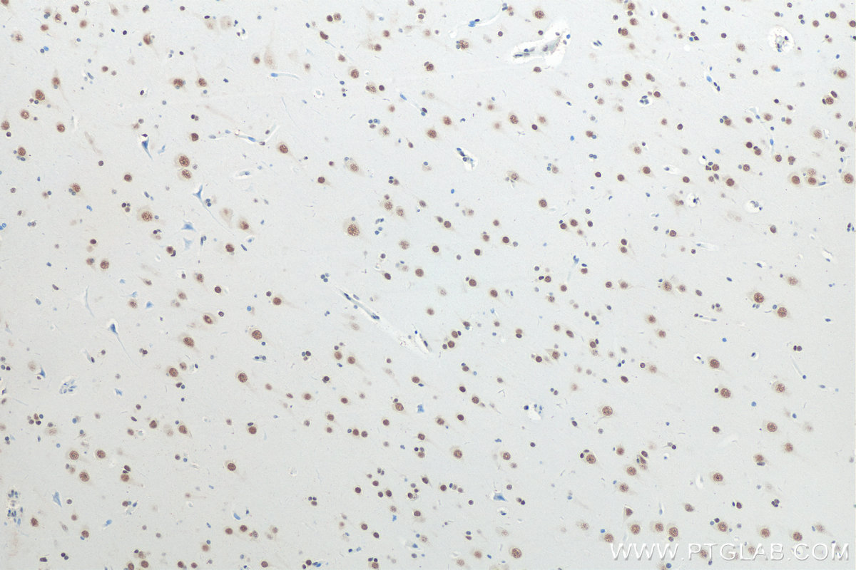 Immunohistochemistry (IHC) staining of human gliomas tissue using Biotin-conjugated TDP-43 Polyclonal antibody (Biotin-10782)