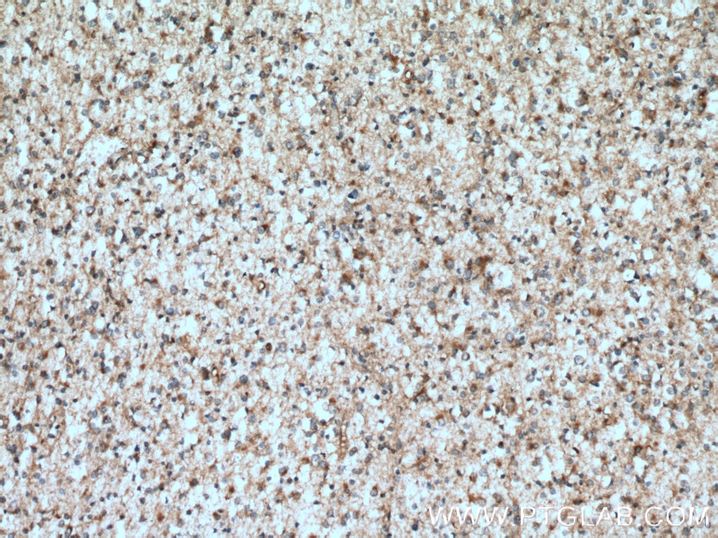 Immunohistochemistry (IHC) staining of human gliomas tissue using TDRKH specific Polyclonal antibody (13528-1-AP)