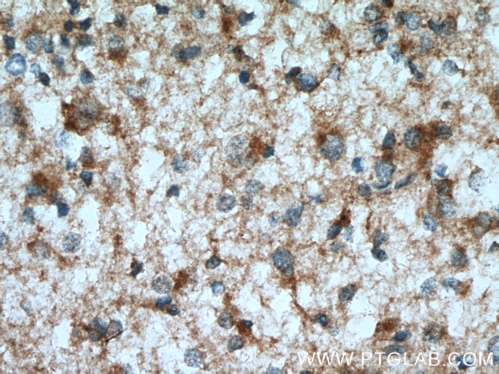 Immunohistochemistry (IHC) staining of human gliomas tissue using TDRKH specific Polyclonal antibody (13528-1-AP)