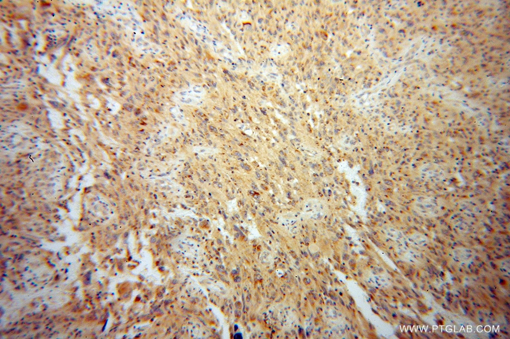 Immunohistochemistry (IHC) staining of human gliomas tissue using TDRKH specific Polyclonal antibody (13528-1-AP)