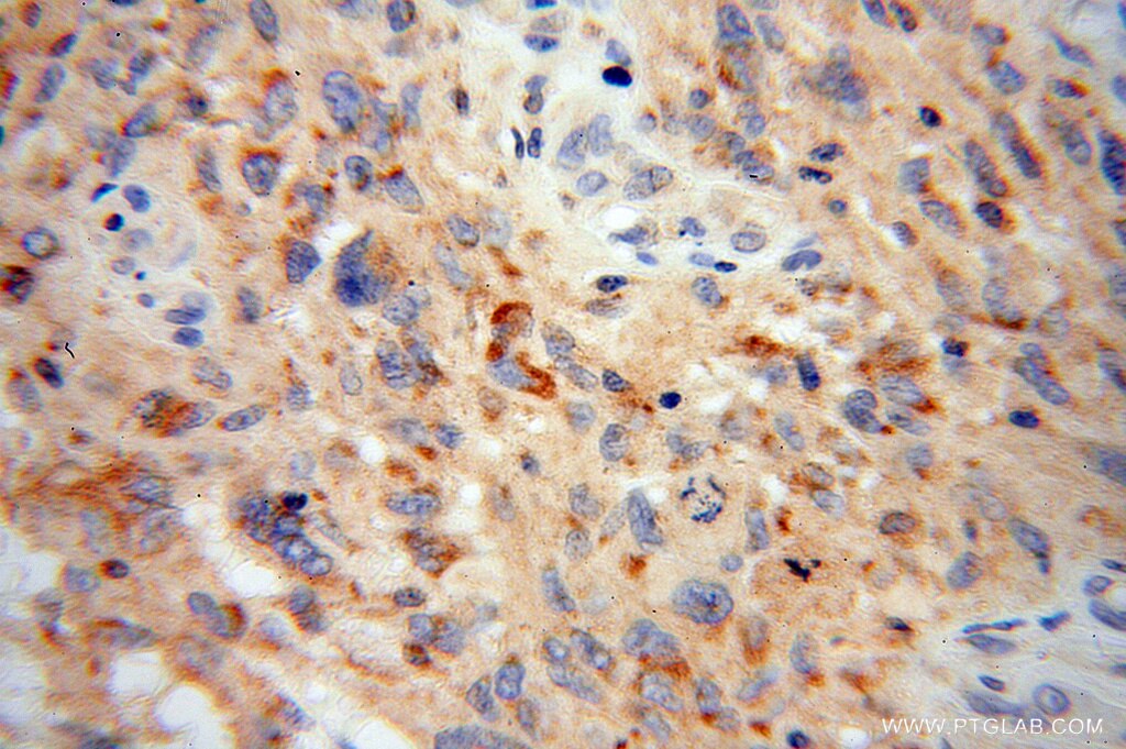 Immunohistochemistry (IHC) staining of human gliomas tissue using TDRKH specific Polyclonal antibody (13528-1-AP)