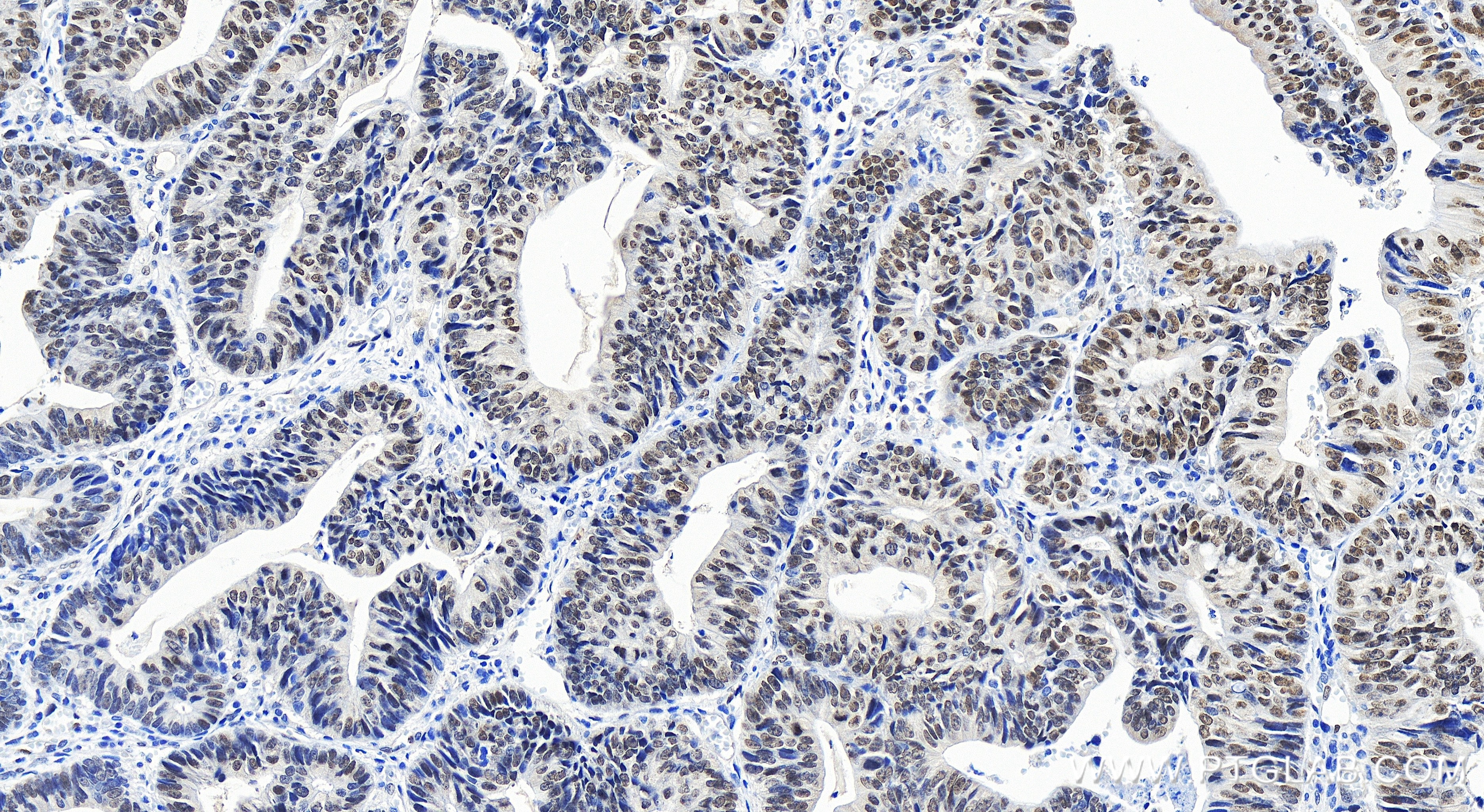 Immunohistochemistry (IHC) staining of human colon cancer tissue using TEAD4 Recombinant antibody (84932-4-RR)