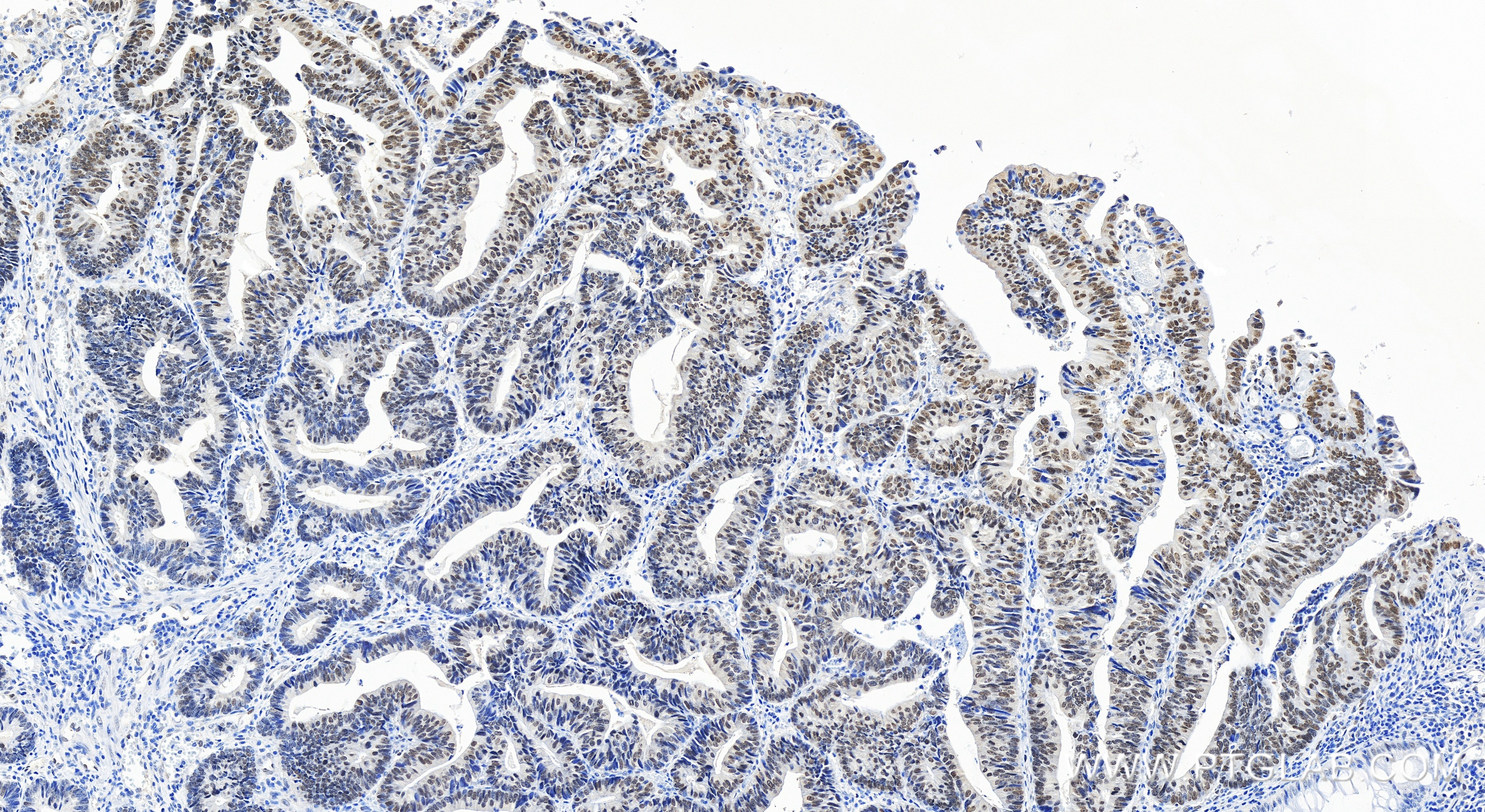 Immunohistochemistry (IHC) staining of human colon cancer tissue using TEAD4 Recombinant antibody (84932-4-RR)