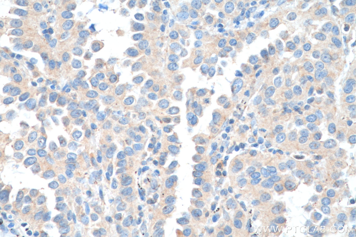 Immunohistochemistry (IHC) staining of human lung cancer tissue using TEC Polyclonal antibody (18085-1-AP)