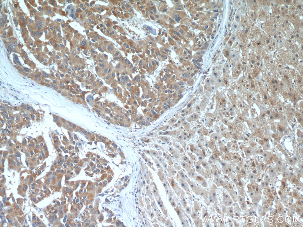 Immunohistochemistry (IHC) staining of human liver cancer tissue using TELO2 Monoclonal antibody (66077-1-Ig)