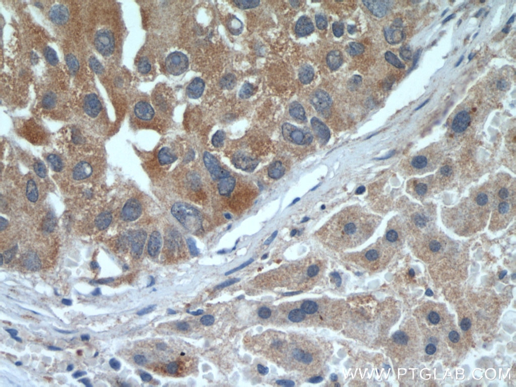 Immunohistochemistry (IHC) staining of human liver cancer tissue using TELO2 Monoclonal antibody (66077-1-Ig)
