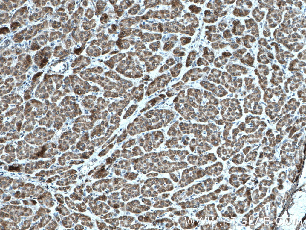 Immunohistochemistry (IHC) staining of human liver cancer tissue using TENC1 Polyclonal antibody (28153-1-AP)