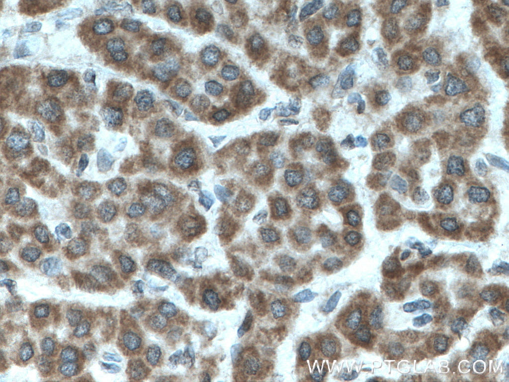 IHC staining of human liver cancer using 28153-1-AP