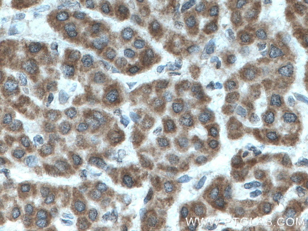 Immunohistochemistry (IHC) staining of human liver cancer tissue using TENC1 Polyclonal antibody (28153-1-AP)