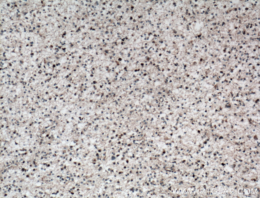 Immunohistochemistry (IHC) staining of human gliomas tissue using TERF1 Polyclonal antibody (11899-1-AP)