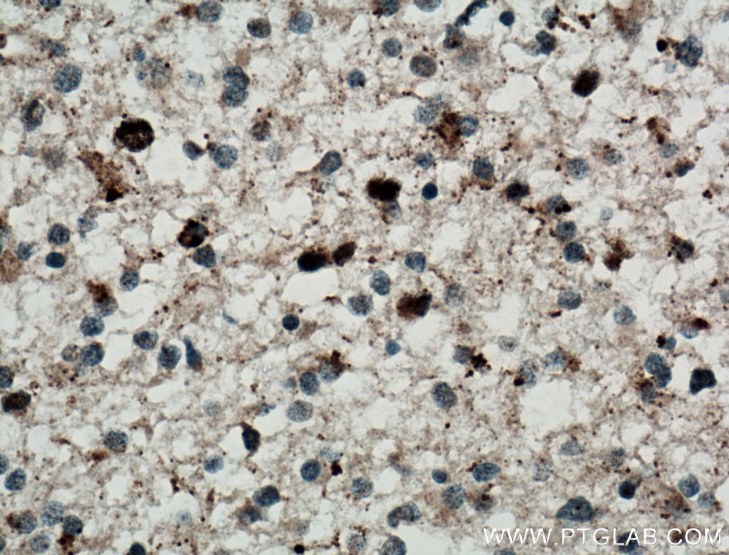 Immunohistochemistry (IHC) staining of human gliomas tissue using TERF1 Polyclonal antibody (11899-1-AP)