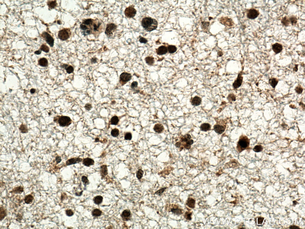 Immunohistochemistry (IHC) staining of human gliomas tissue using TERF2 Polyclonal antibody (22020-1-AP)