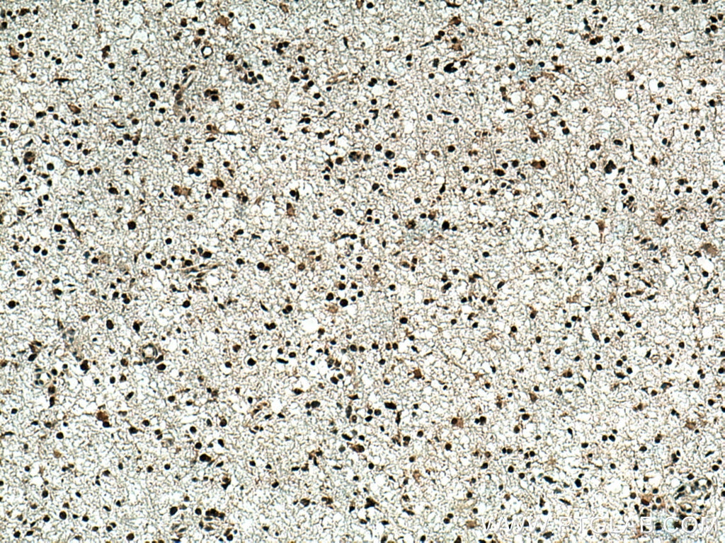 Immunohistochemistry (IHC) staining of human gliomas tissue using TERF2 Polyclonal antibody (22020-1-AP)