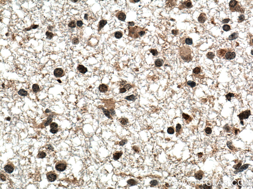 Immunohistochemistry (IHC) staining of human gliomas tissue using TERF2 Monoclonal antibody (66893-1-Ig)