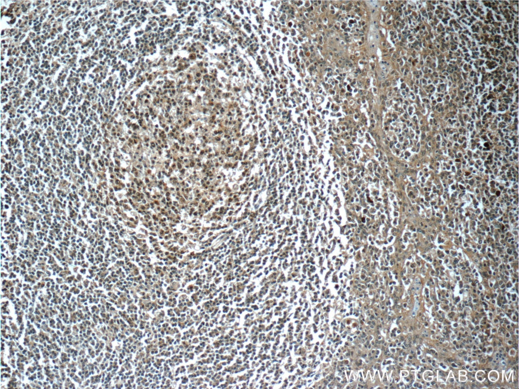 Immunohistochemistry (IHC) staining of human tonsillitis tissue using TERF2IP Polyclonal antibody (14595-1-AP)
