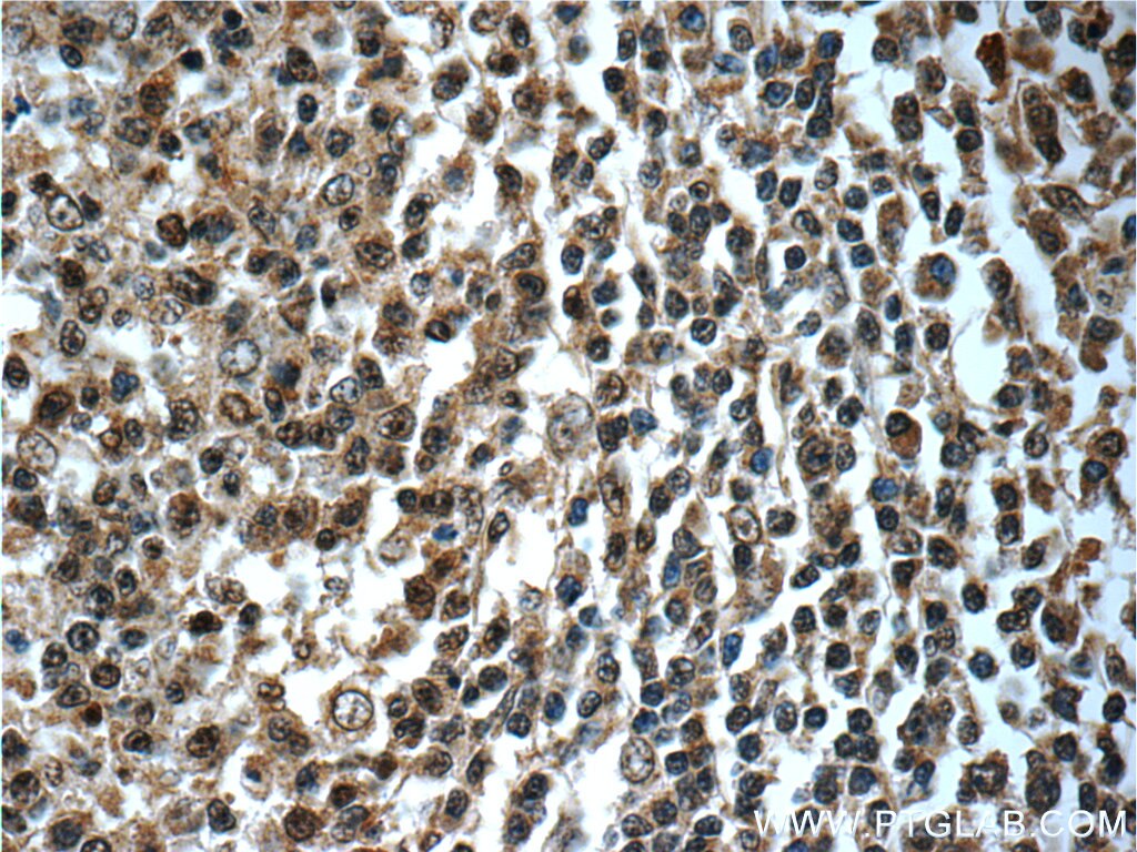 Immunohistochemistry (IHC) staining of human tonsillitis tissue using TERF2IP Polyclonal antibody (14595-1-AP)
