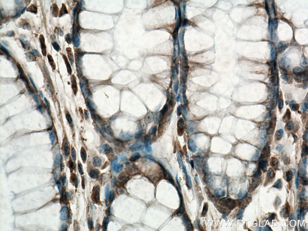 Immunohistochemistry (IHC) staining of human colon cancer tissue using TESC Polyclonal antibody (11125-1-AP)