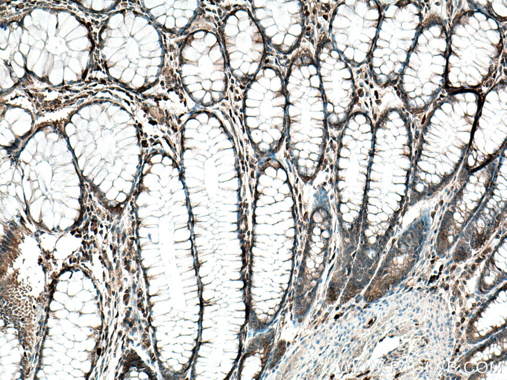 Immunohistochemistry (IHC) staining of human colon cancer tissue using TESC Polyclonal antibody (11125-1-AP)