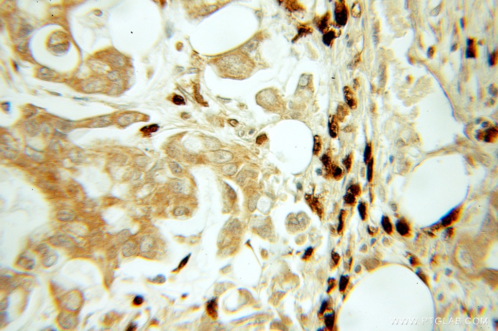 Immunohistochemistry (IHC) staining of human pancreas cancer tissue using TESC Polyclonal antibody (11125-1-AP)