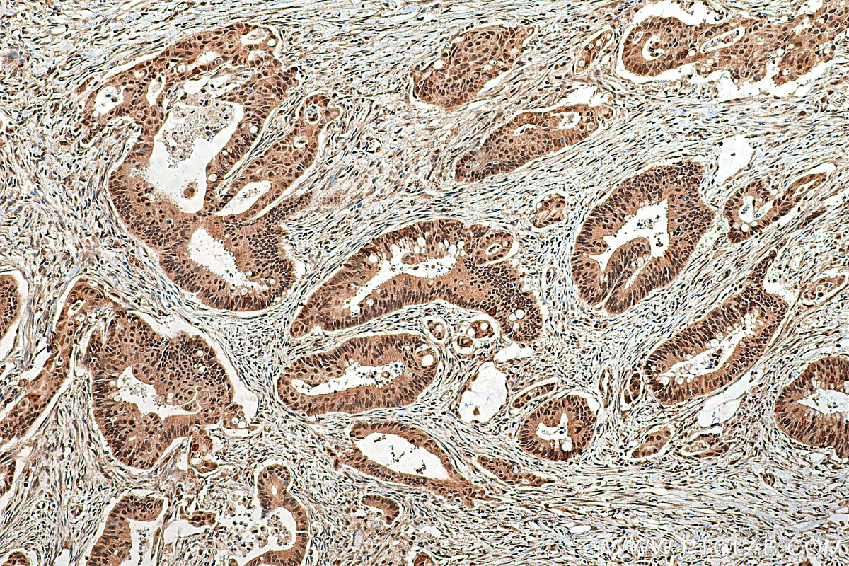 Immunohistochemistry (IHC) staining of human colon cancer tissue using TET2 Polyclonal antibody (21207-1-AP)