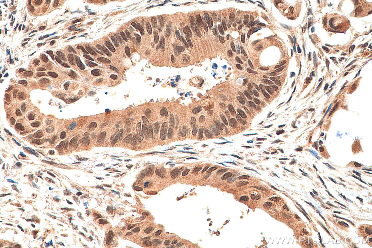Immunohistochemistry (IHC) staining of human colon cancer tissue using TET2 Polyclonal antibody (21207-1-AP)