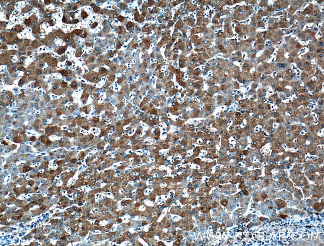 Immunohistochemistry (IHC) staining of human hepatocirrhosis tissue using Transferrin Polyclonal antibody (17435-1-AP)