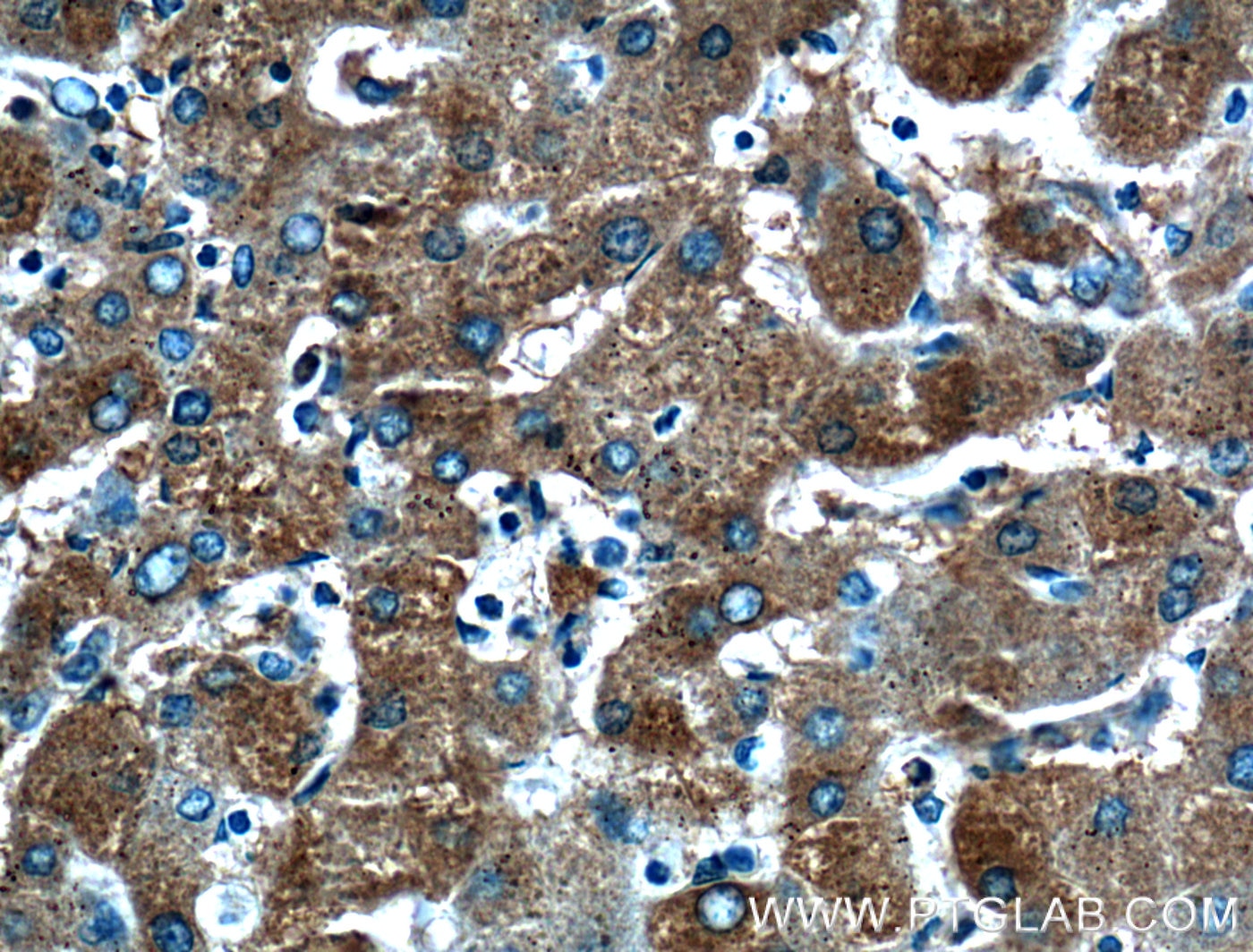 Immunohistochemistry (IHC) staining of human hepatocirrhosis tissue using Transferrin Polyclonal antibody (17435-1-AP)