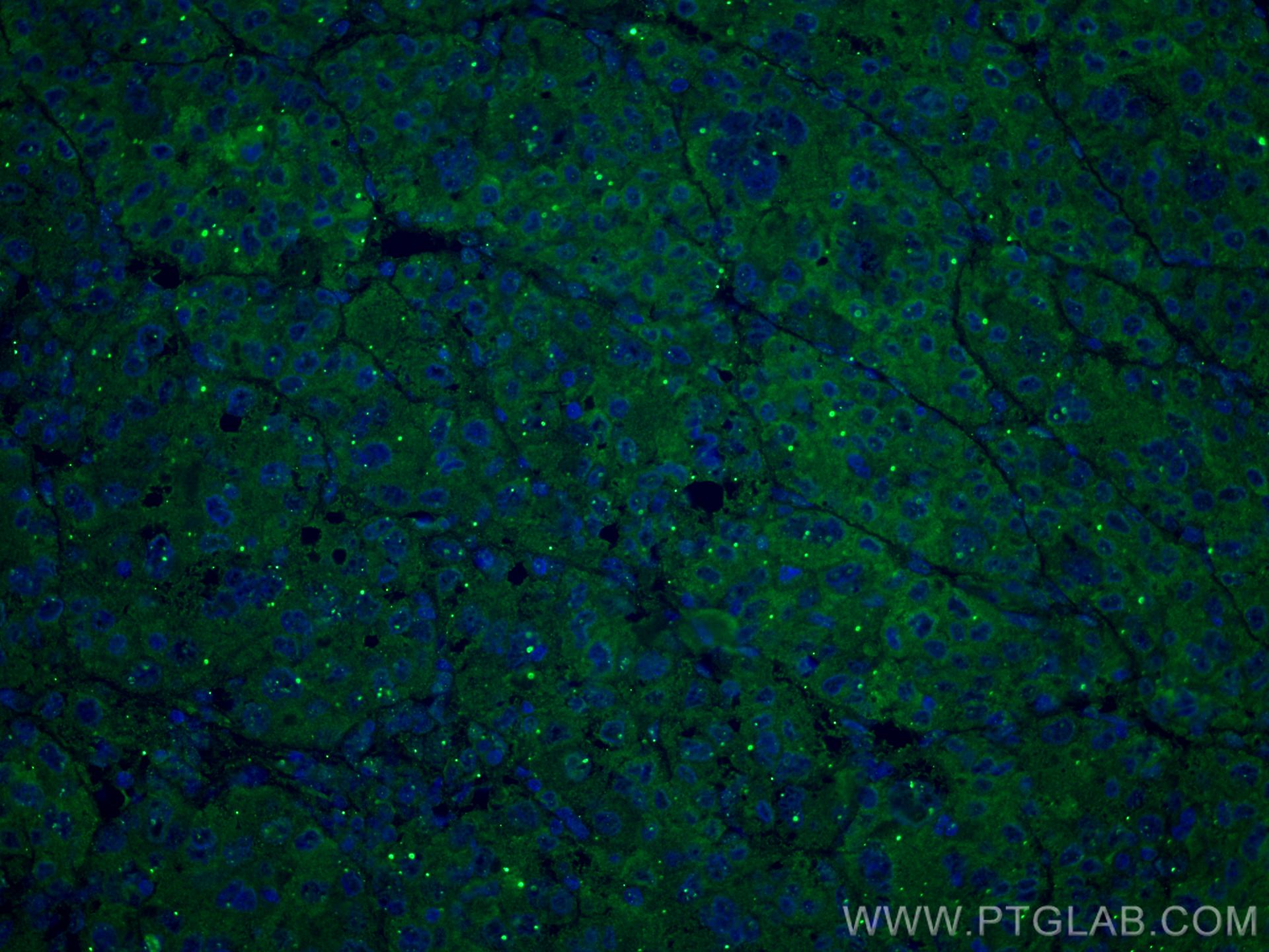 Immunofluorescence (IF) / fluorescent staining of human liver cancer tissue using Transferrin Monoclonal antibody (66171-1-Ig)