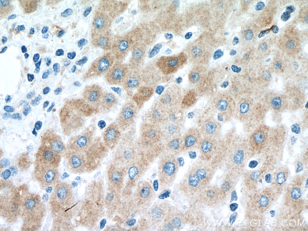 IHC staining of human liver cancer using 66171-1-Ig