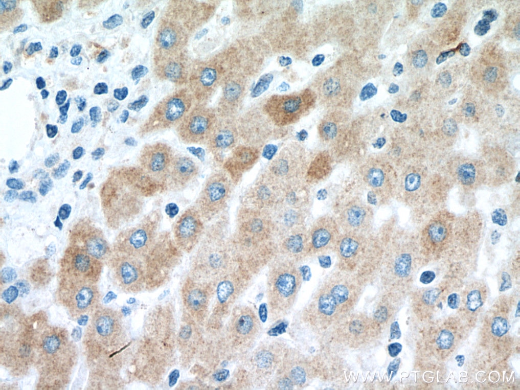 Immunohistochemistry (IHC) staining of human liver cancer tissue using Transferrin Monoclonal antibody (66171-1-Ig)