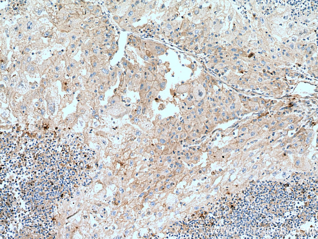 Immunohistochemistry (IHC) staining of human liver cancer tissue using Transferrin Monoclonal antibody (66171-1-Ig)