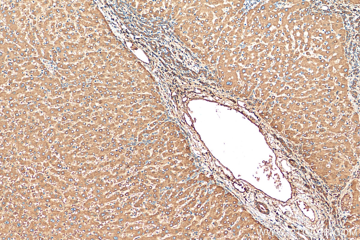 IHC staining of human hepatocirrhosis using 81676-1-RR