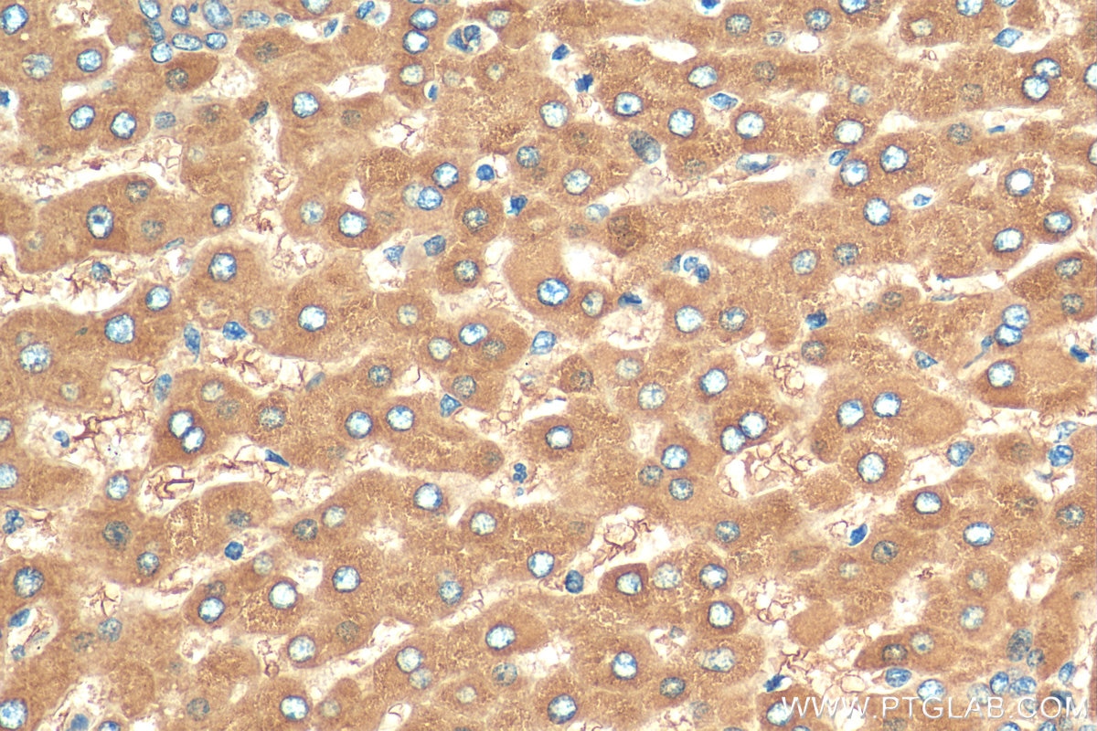 Immunohistochemistry (IHC) staining of human hepatocirrhosis tissue using Transferrin Recombinant antibody (81676-1-RR)