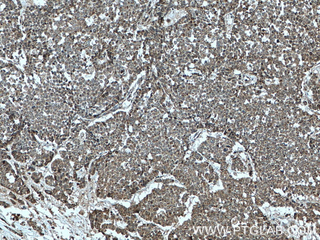 Immunohistochemistry (IHC) staining of human colon cancer tissue using TFAM Polyclonal antibody (19998-1-AP)