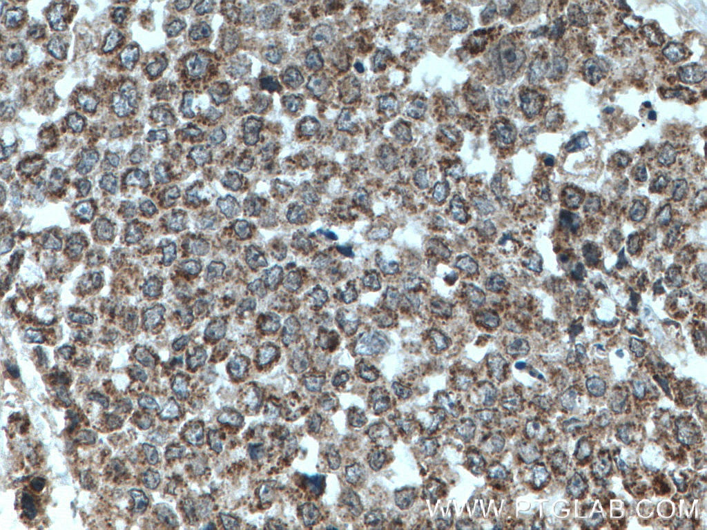 IHC staining of human colon cancer using 19998-1-AP