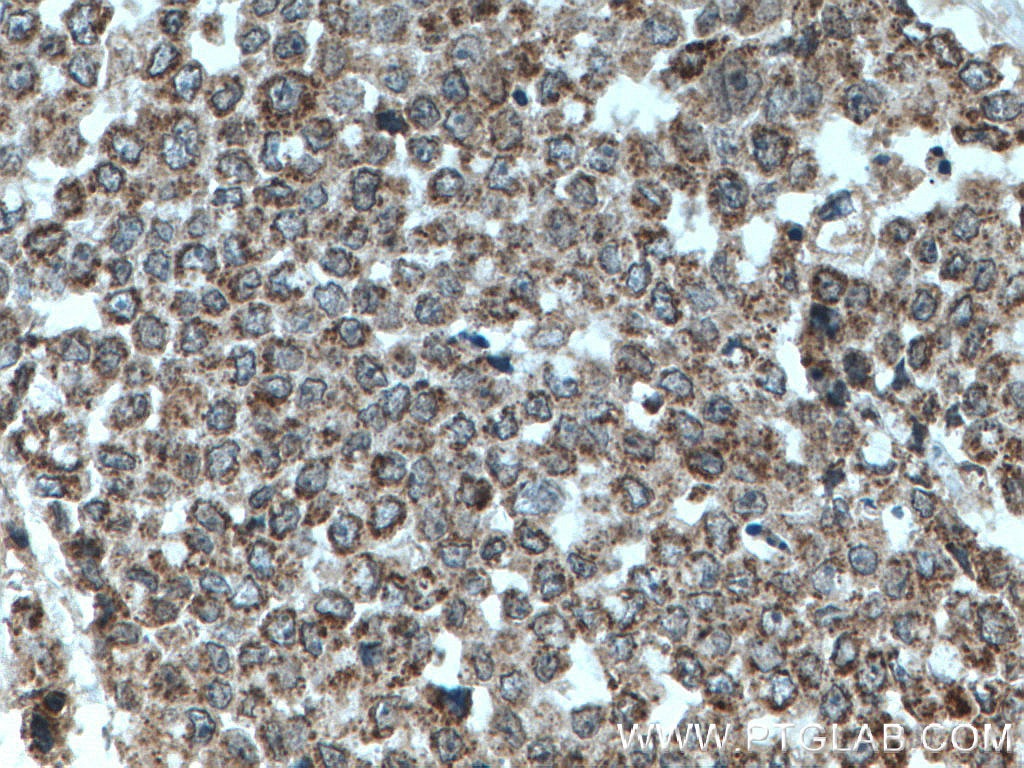 Immunohistochemistry (IHC) staining of human colon cancer tissue using TFAM Polyclonal antibody (19998-1-AP)